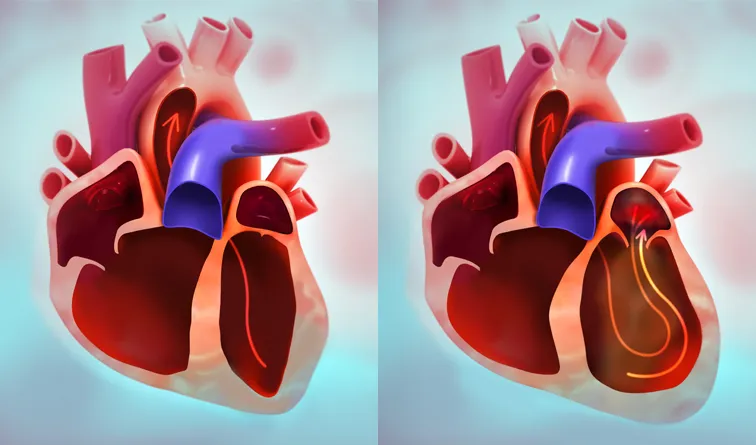 Mitral Regurgitation