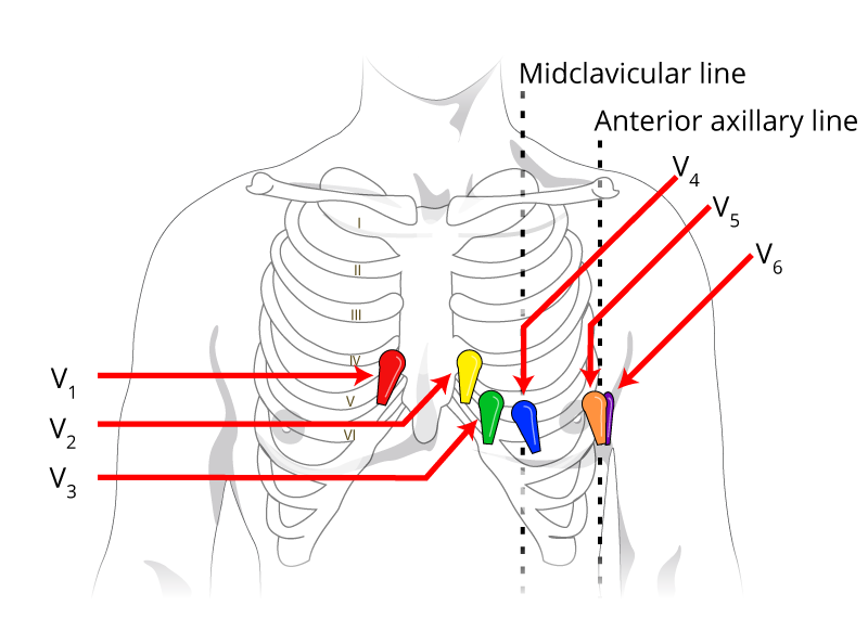 12 lead ecg placement color coded